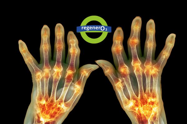 La Ozonoterapia como tratamiento de la Artritis Reumatoide